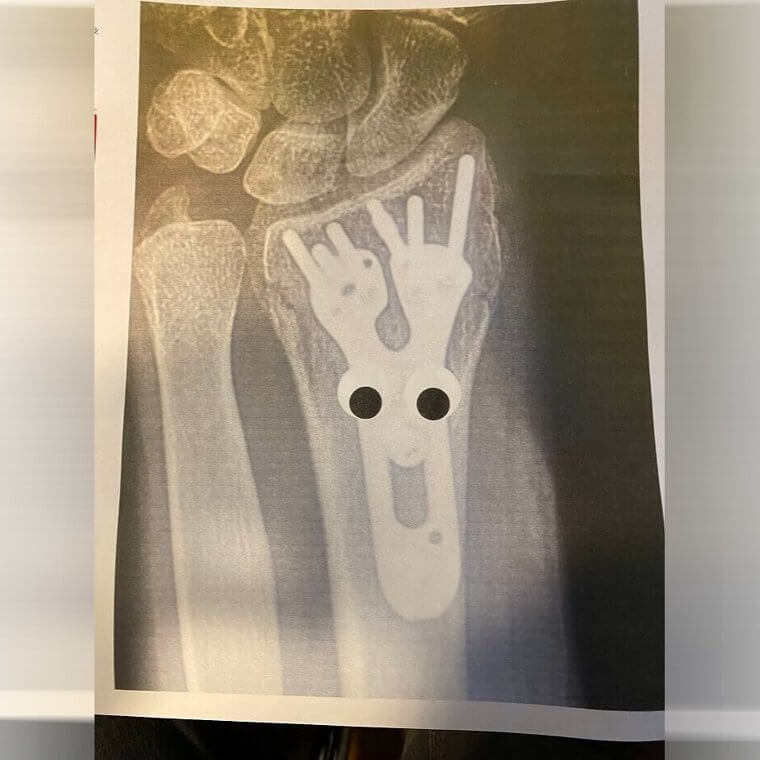 Googly Eyes on an X-Ray